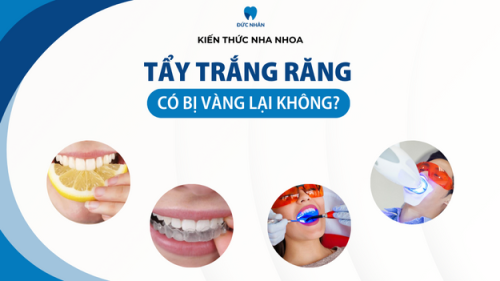 Tẩy trắng răng có bị vàng lại không? Mẹo giữ răng tẩy trắng hiệu quả?